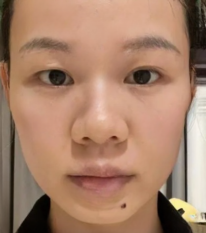 去眼袋手术