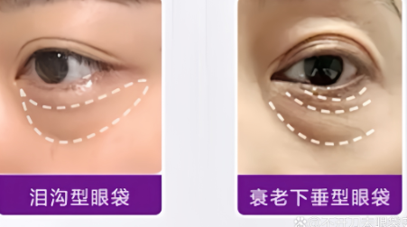 去眼袋手术