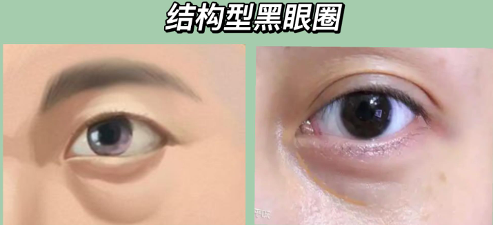 去眼袋手术