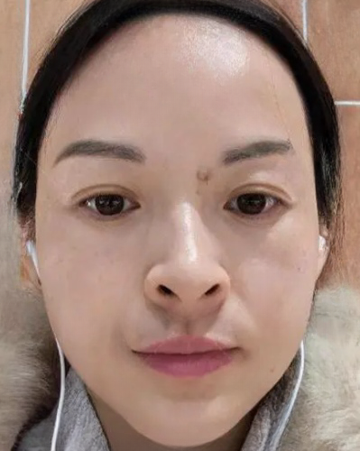 去眼袋手术