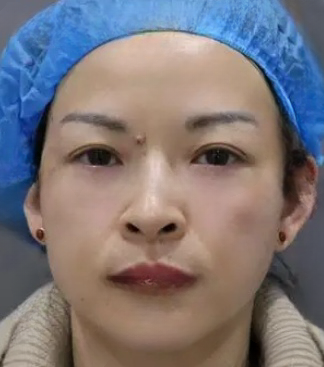 去眼袋手术