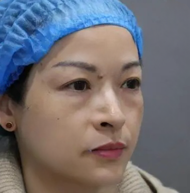 去眼袋手术