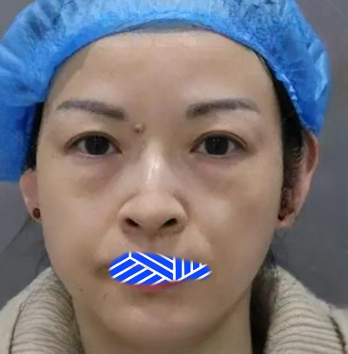 去眼袋手术