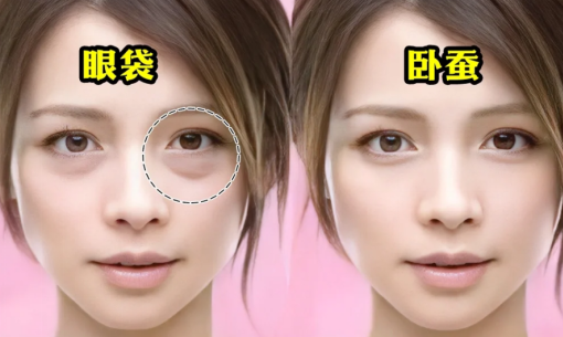 去眼袋手术