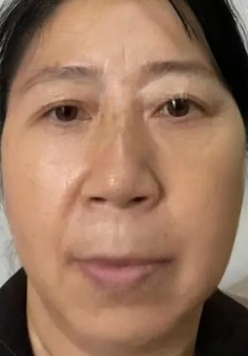 去眼袋手术