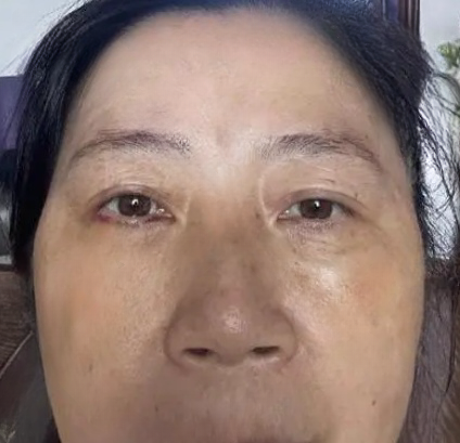 去眼袋手术