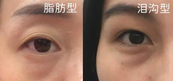 去眼袋手术