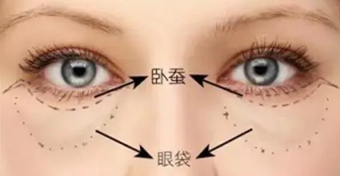 去眼袋手术