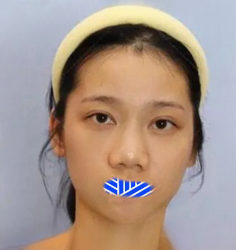 去眼袋手术