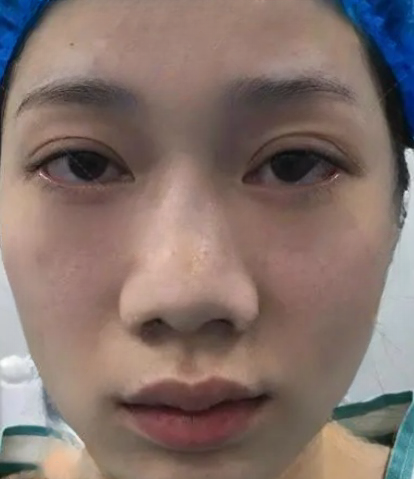 去眼袋手术