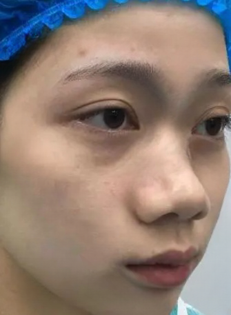 去眼袋手术