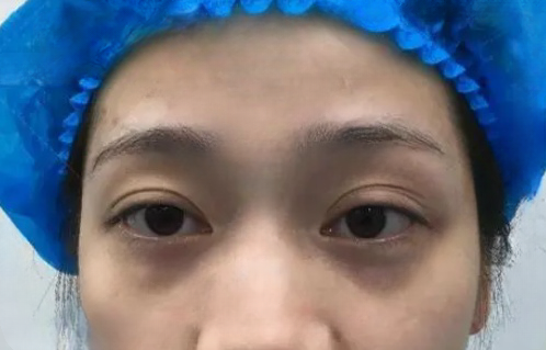 去眼袋手术