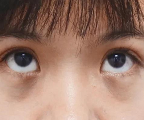 去眼袋手术