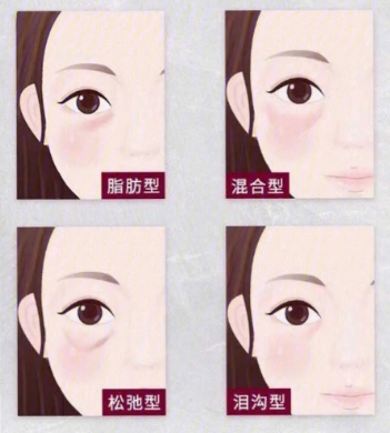 去眼袋手术