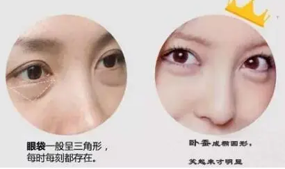 去眼袋手术