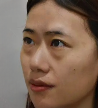 去眼袋手术