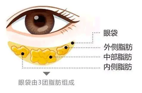 去眼袋手术