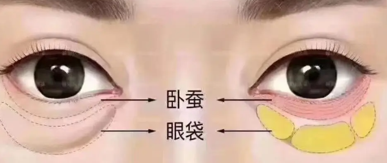 去眼袋手术