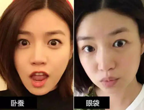 去眼袋手术