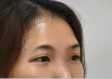 去眼袋手术