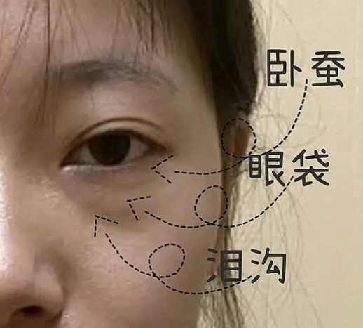 去眼袋手术