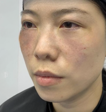 去眼袋手术
