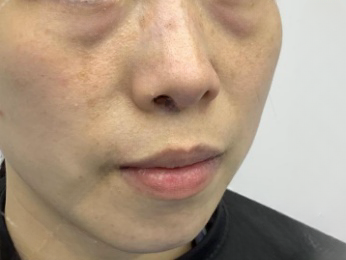 去眼袋手术