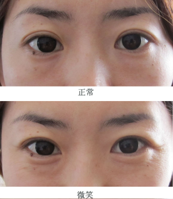 眼袋