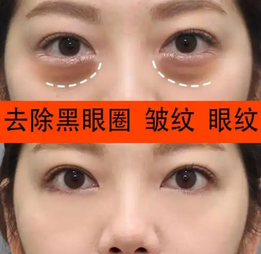 眼袋