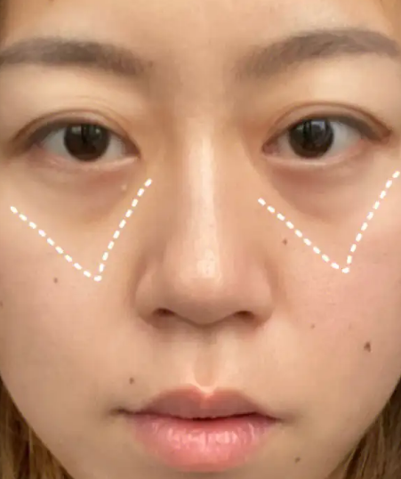 眼袋