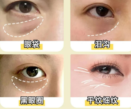 眼袋