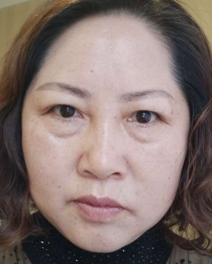 去眼袋手术