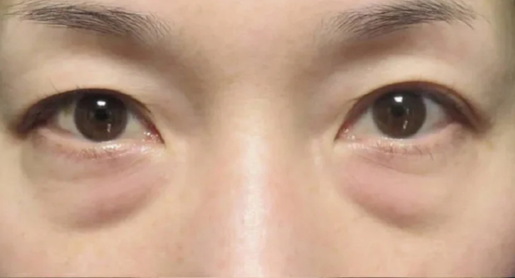 去眼袋手术