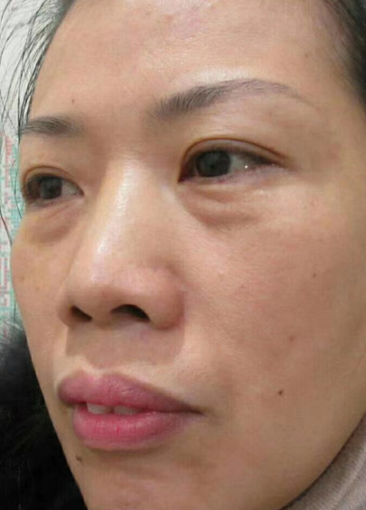 去眼袋手术