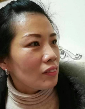 去眼袋手术