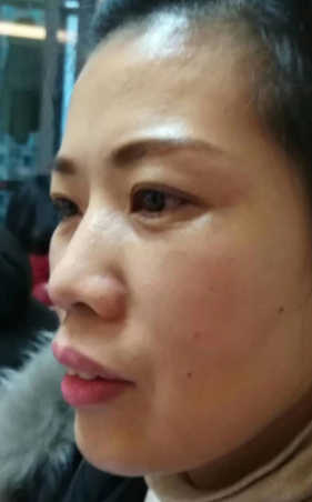 去眼袋手术