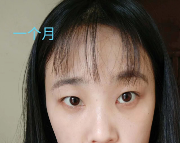 去眼袋手术