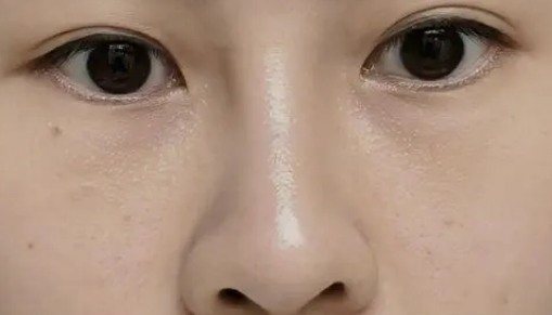 眼袋