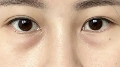 眼袋