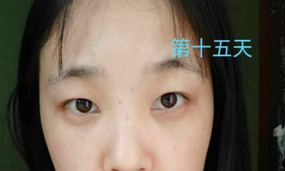 去眼袋手术