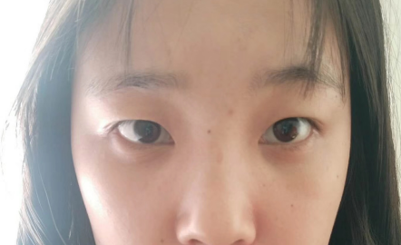 去眼袋手术