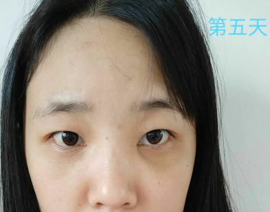 去眼袋手术