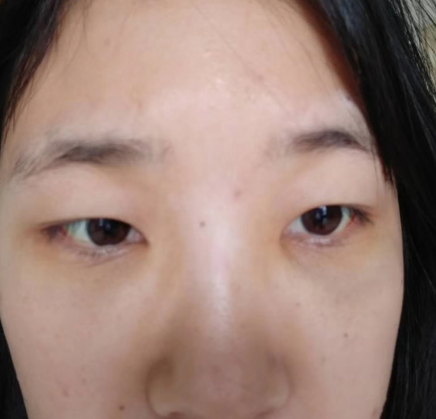 去眼袋手术