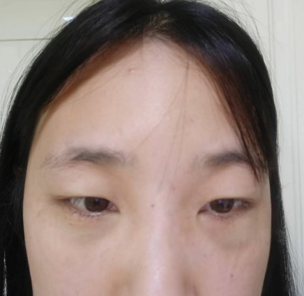 去眼袋手术