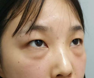去眼袋手术