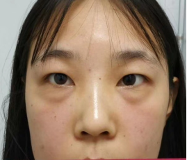 去眼袋手术