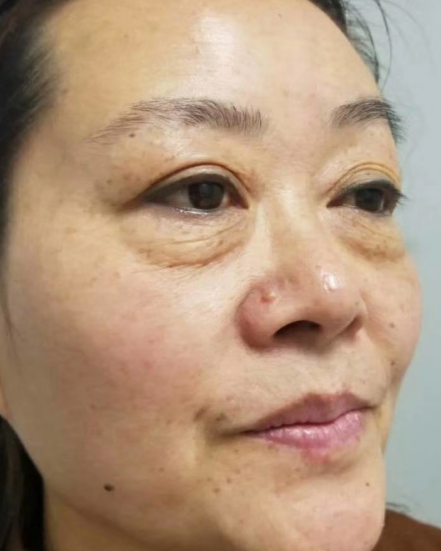 去眼袋手术