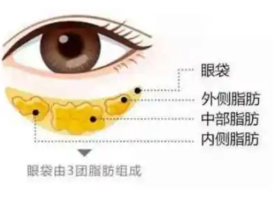 去眼袋手术