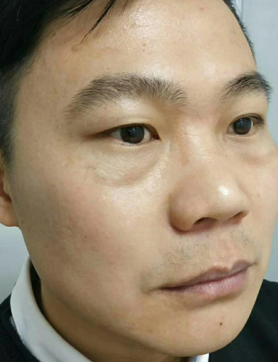 去眼袋手术
