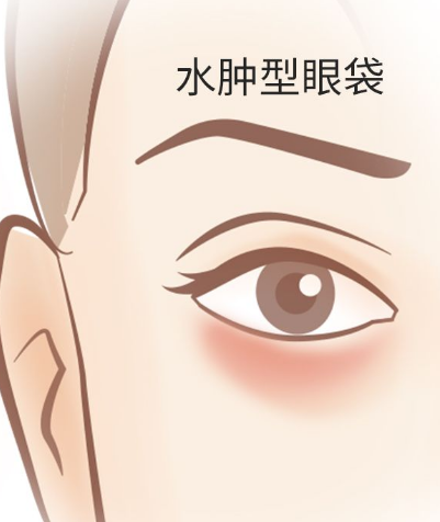 去眼袋手术